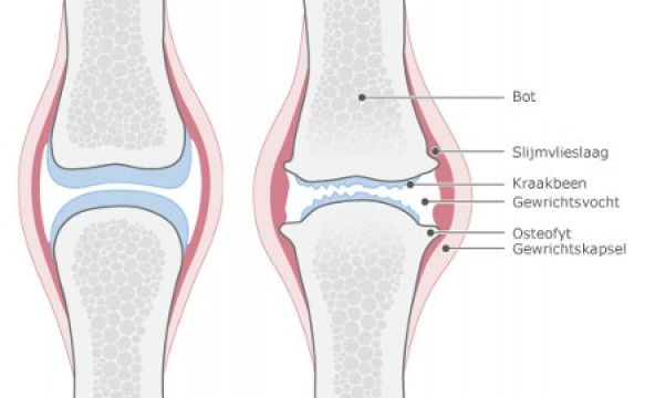 Knieatrose, een versleten knie