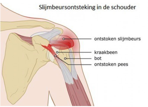 Schouderpijn en ontsteking